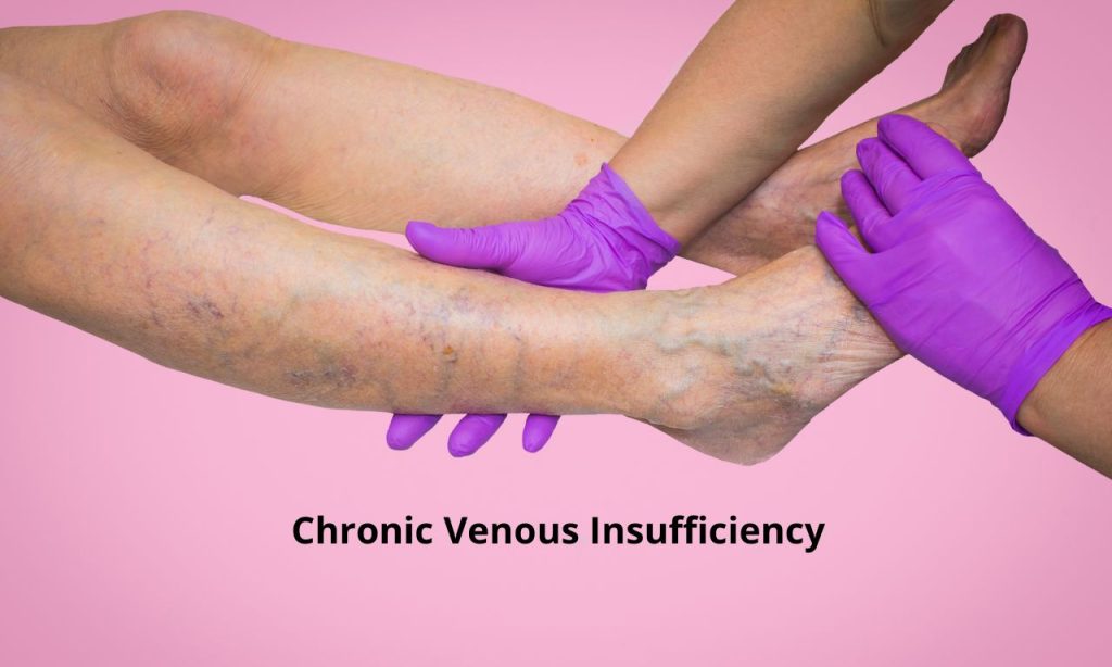 Chronic Venous Insufficiency: Symptoms and Treatment
