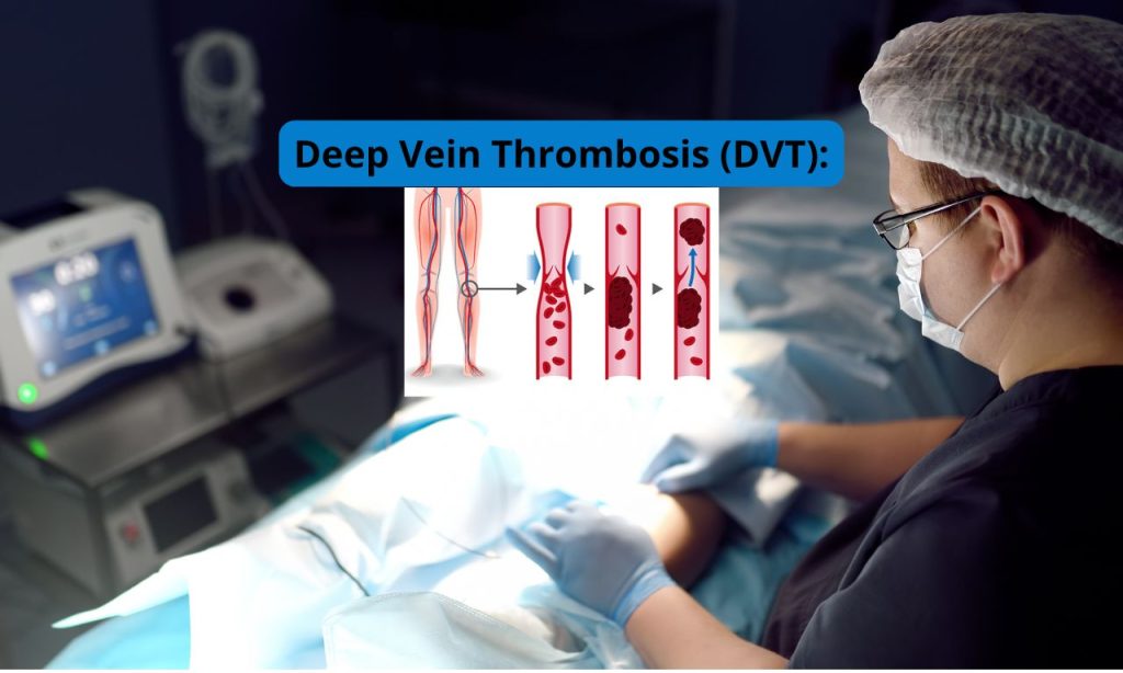 Deep Vein Thrombosis (DVT): Symptoms and Prevention