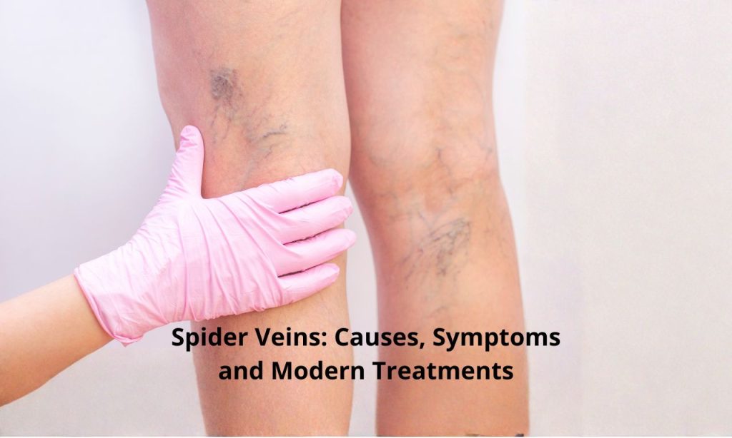 Spider Veins: Causes, Symptoms and Modern Treatments