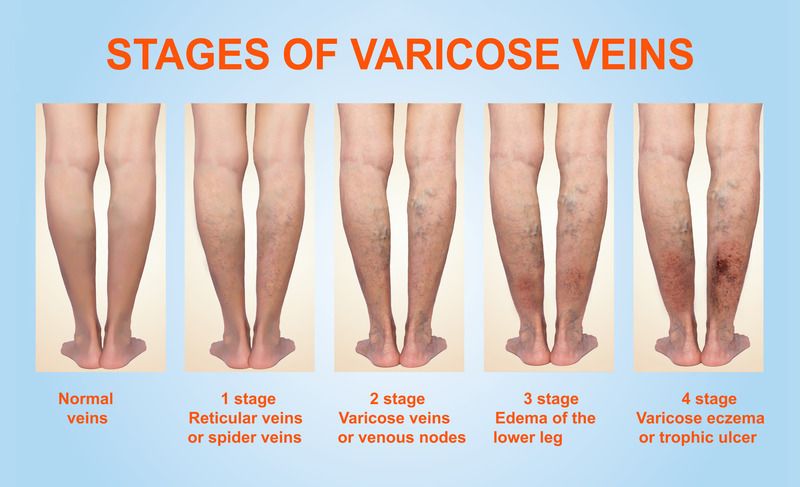 Varicose Veins: Causes, Symptoms and Treatment Options
